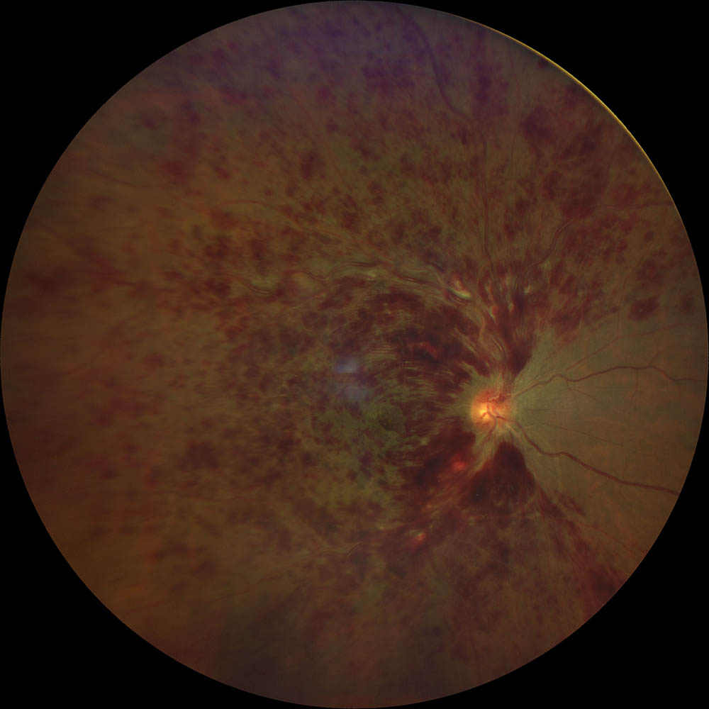 Retinal Scan With Rvo Winner of January 2023 – Vitreo Retina Society