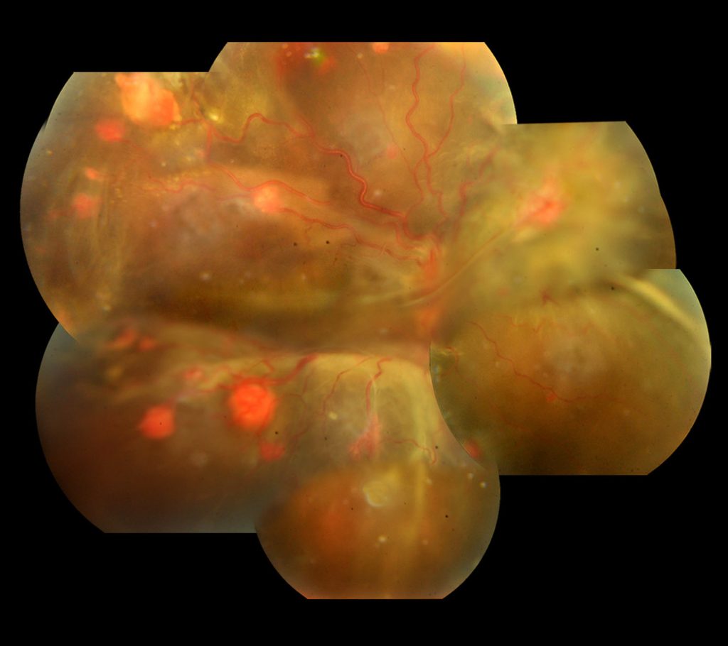 Winner of April May & June 2022 – Vitreo Retina Society